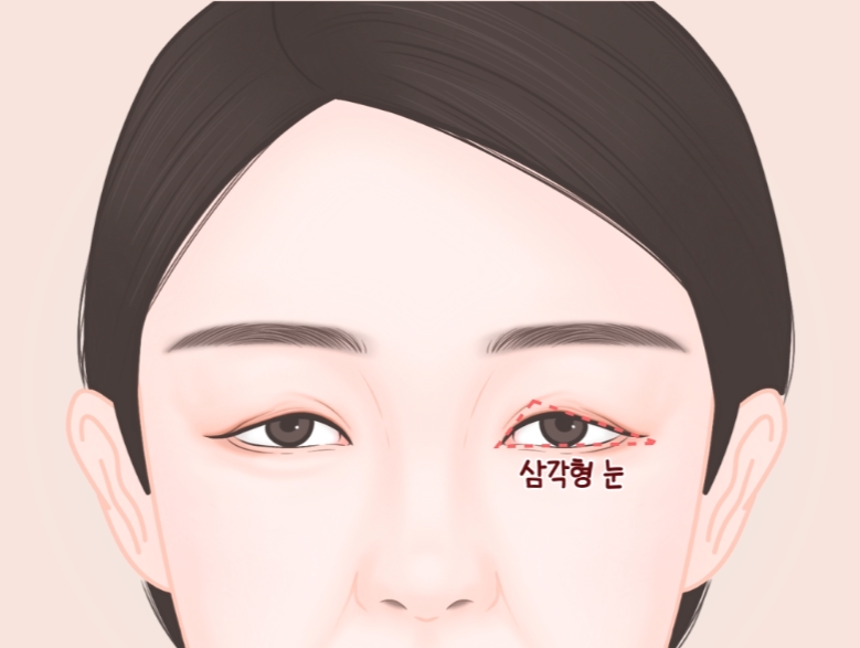 Differences Between Upper Eyelid Lift and Upper Blepharoplasty, and Brow Lift Scars: Explained by a Board-Certified Plastic Surgeon image 4