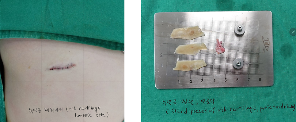 코끝떨어짐 늑연골 재수술 관련 이미지 5