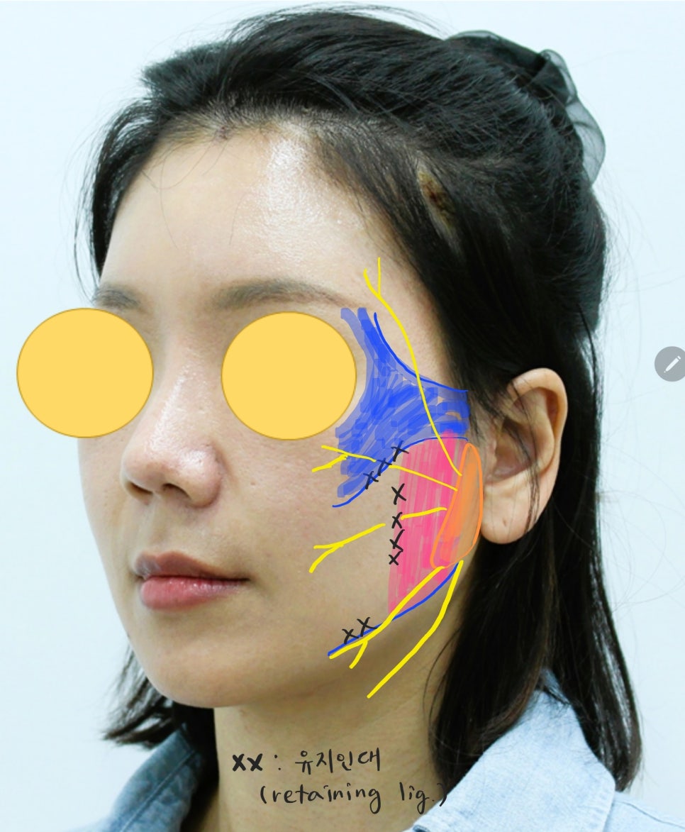 Areas of the Face Improved by a Deep Mini Facelift image 4