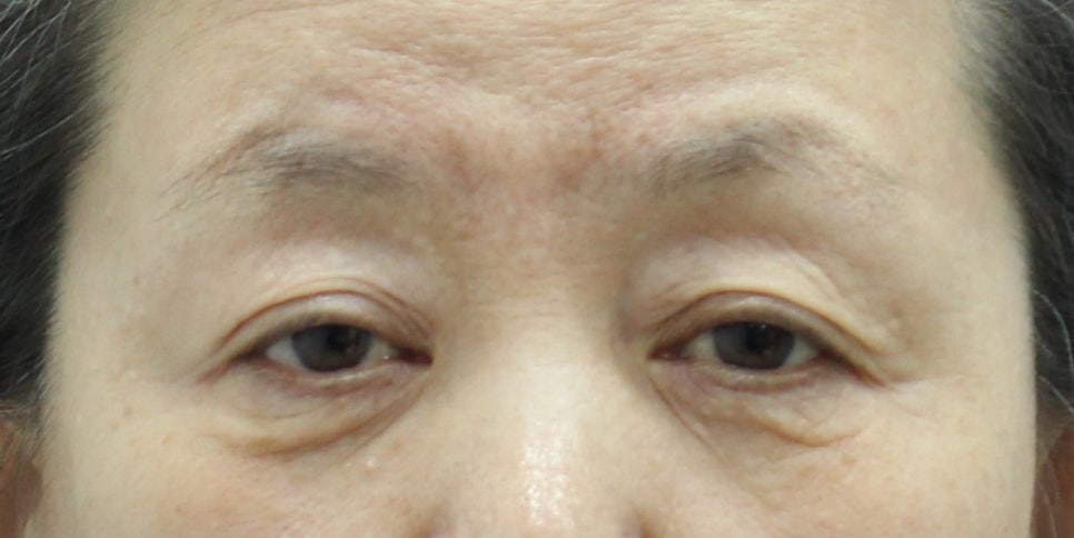 안검외반의 위험성을 예측하고 예방하는 하안검 관련 이미지 1