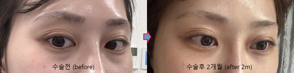 눈밑지방재배치, 복시&middot;사시는 걱정해야 할까요? (드문 부작용과 회복 과정) 관련 이미지 5