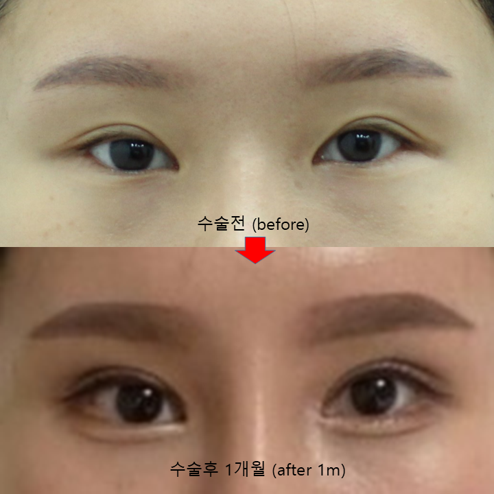 앞트임 재수술에서 윗트임의 중요성 관련 이미지 7