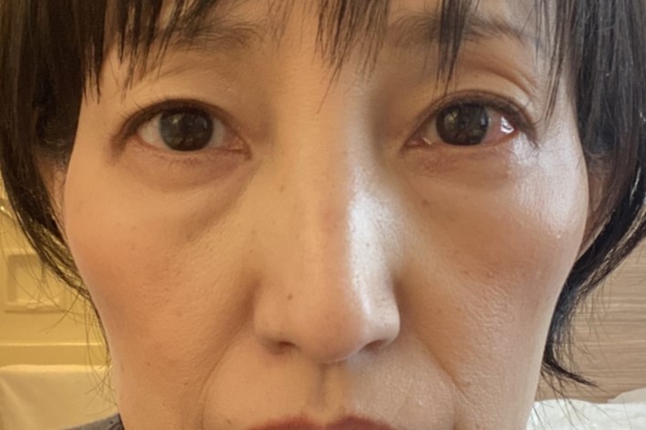 Facial Aging After Successful Weight Loss: Causes and Solutions for Ozempic Face image 3