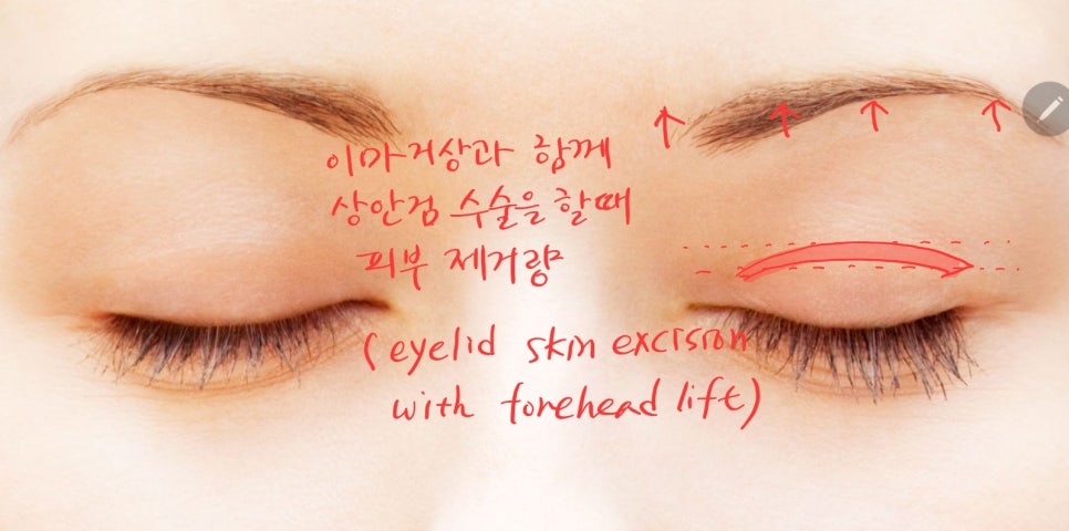 상안검 성형과 이마거상을 함께 했을 때 장점 관련 이미지 4