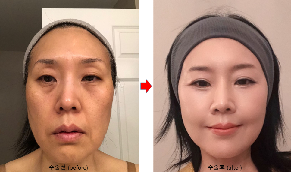 북미교포 성형수술. 해외교포(동포)성형 관련 이미지 7