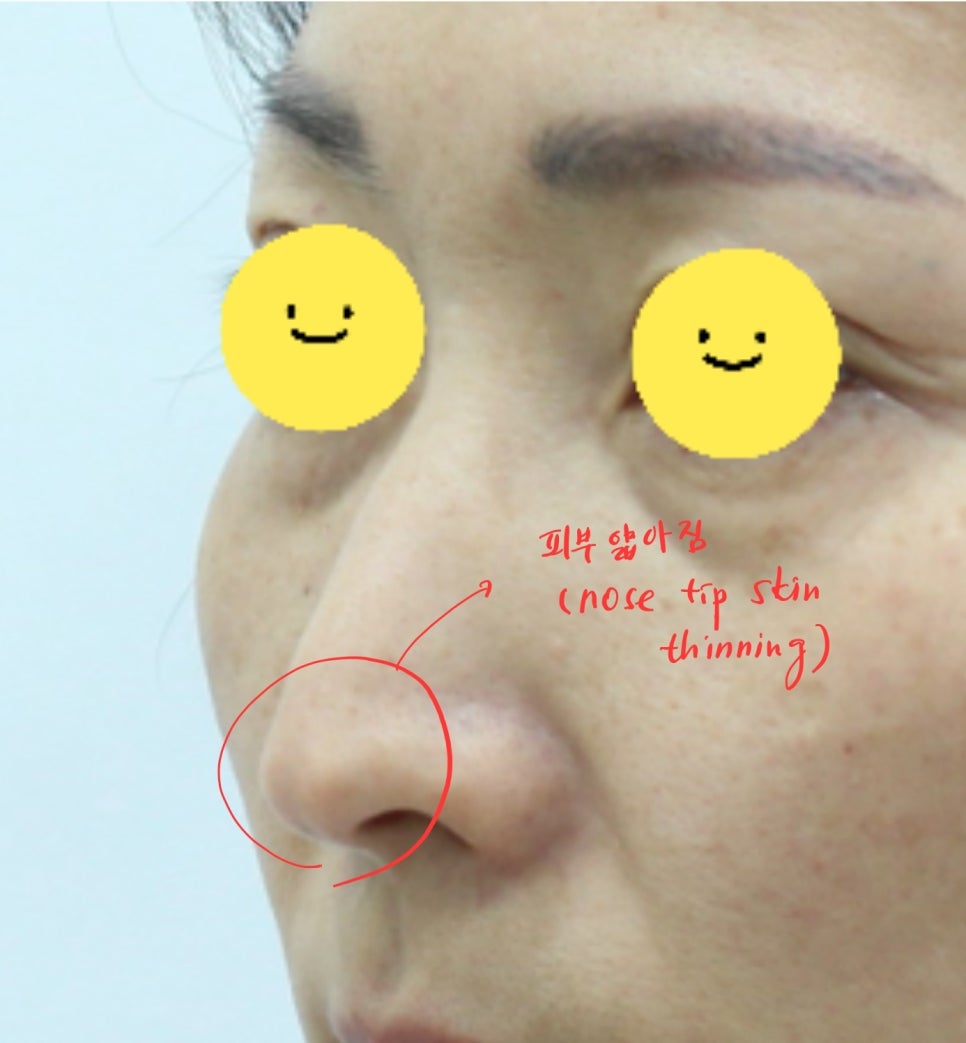 The Aging Process of the Nose and Midlife Rhinoplasty image 6