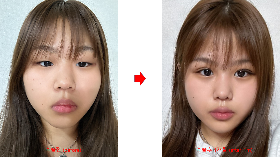 First-Eye Surgery with a Non-Incision Method (Buried Suture Double-Eyelid Surgery) image 6