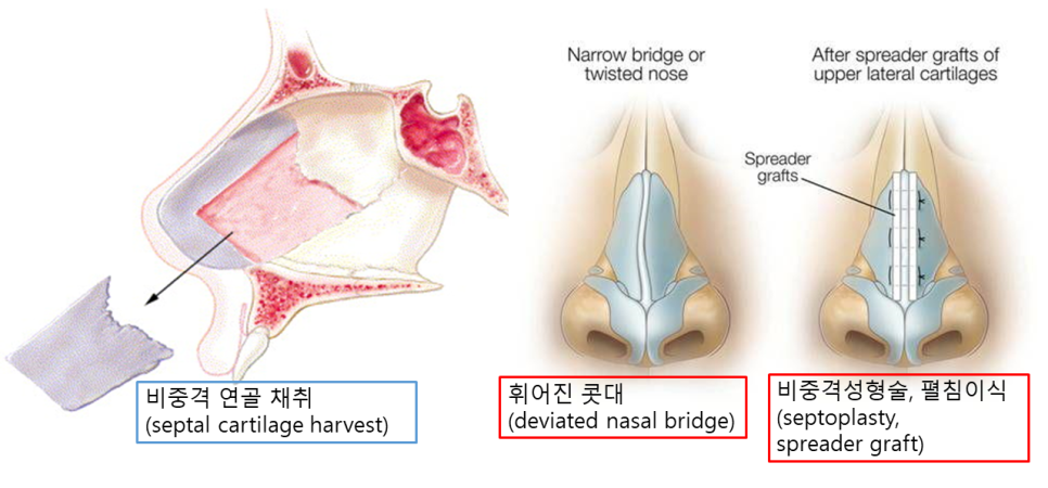 무보형물 코성형, 휜코까지 교정할 수 있을까? 관련 이미지 2