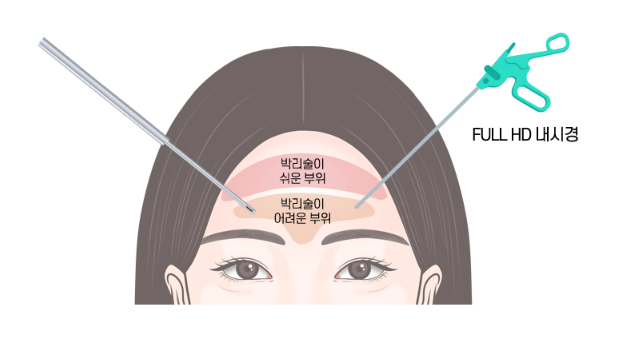 내시경 이마거상과 함께 시행한 골종제거 관련 이미지 5