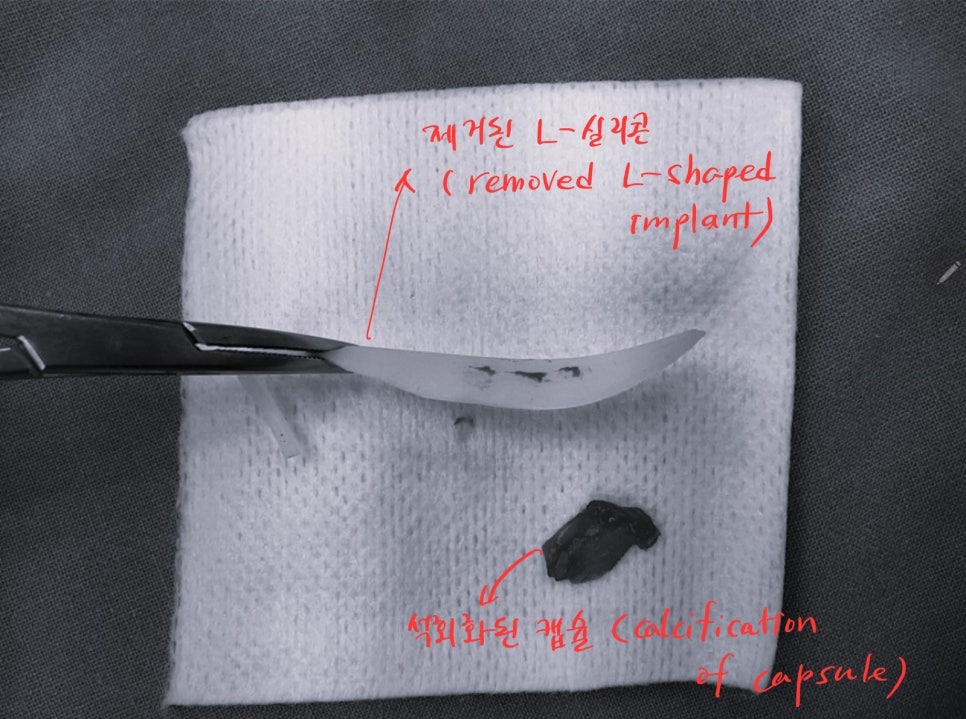 Use of Rib Cartilage in Midlife Rhinoplasty image 6