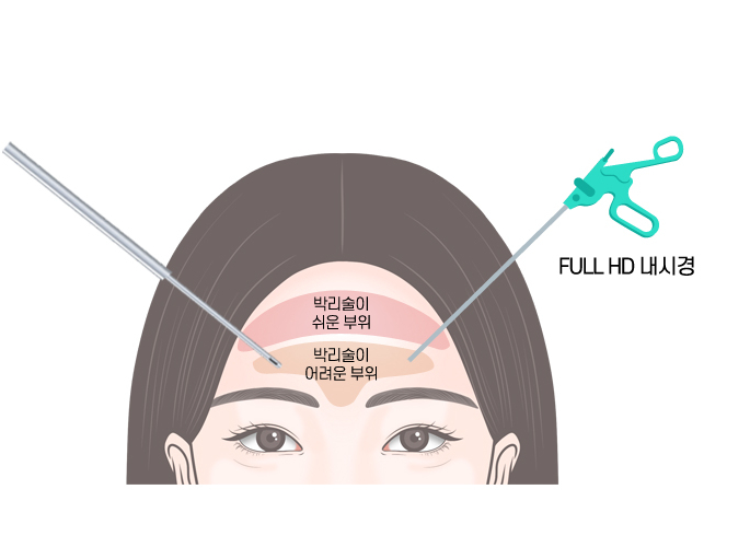 【Garnet Plastic Surgery Dr. Baek Insoo’s Plastic Surgery Column】 Fast Recovery After Pentafix Forehead Lift image 3