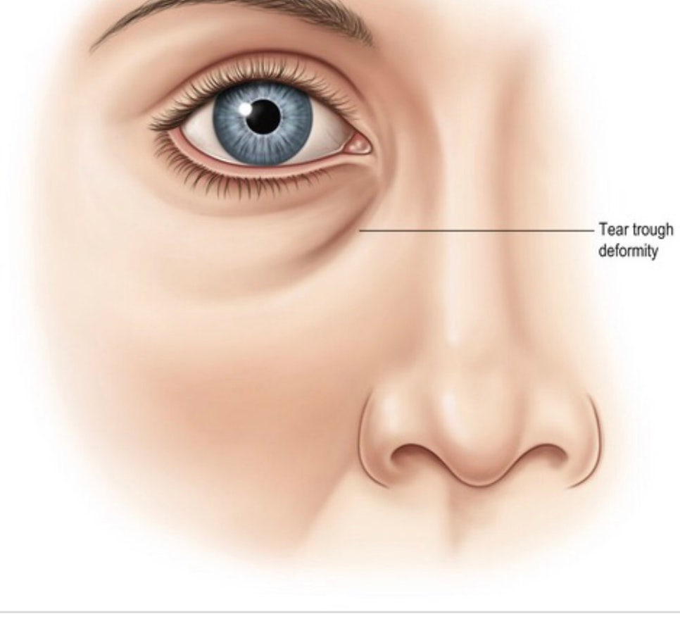Types of Under-Eye Hollowness and Correction Methods image 1
