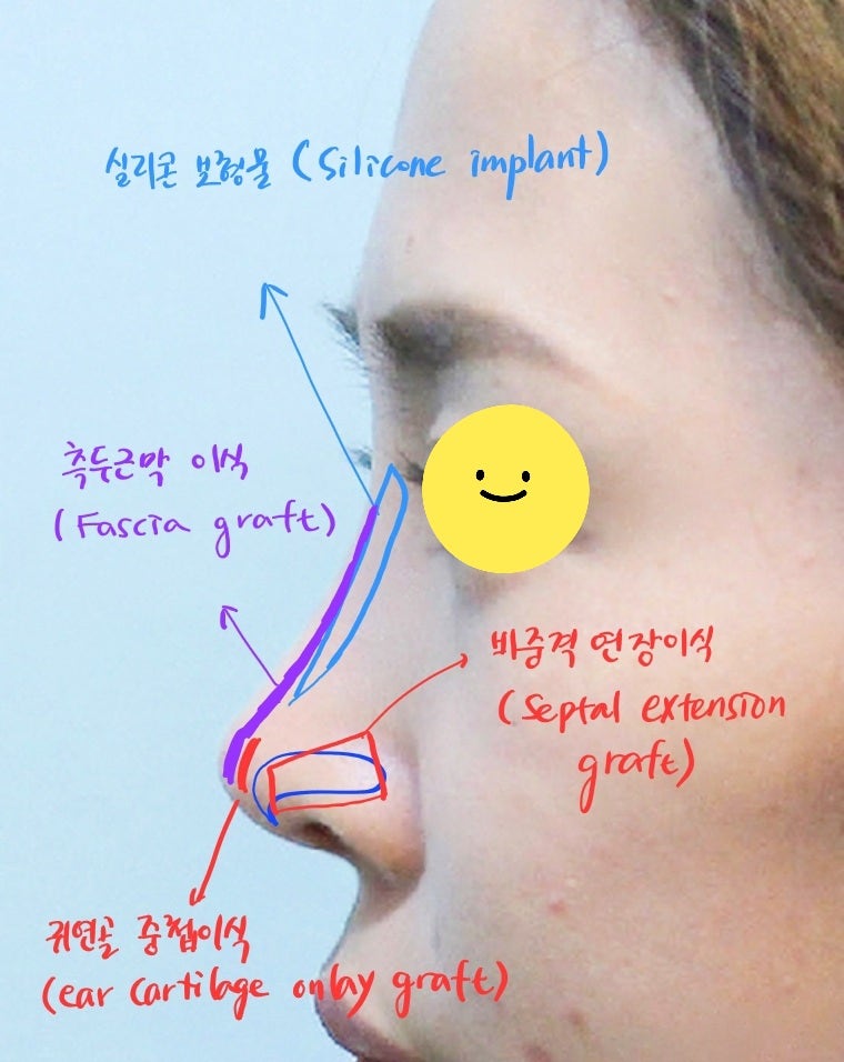 코재수술에서 얇아진 피부를 보강하는 방법 관련 이미지 5