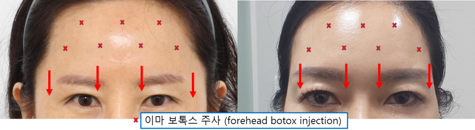 이마주름은 보톡스로 펴졌는데, 왜 눈은 더 무거워질까? 관련 이미지 2