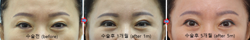 쌍꺼풀 재수술 흉터, 피부결을 따라야 자연스럽습니다 관련 이미지 6