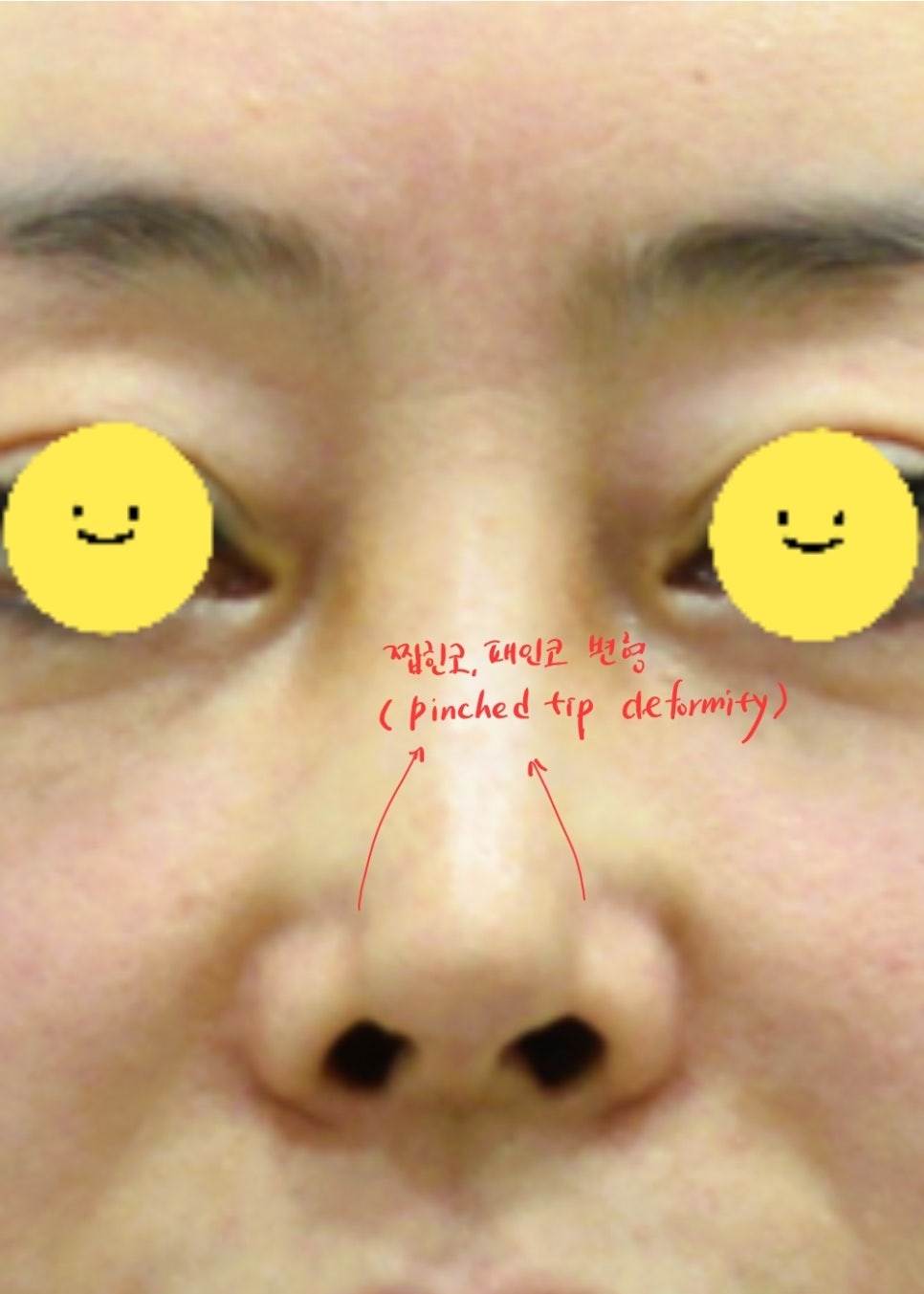 Correction of a Pinched Nose or Indented Nose image 2