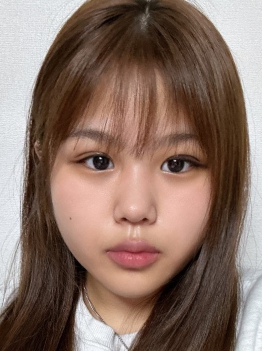 First-Eye Surgery with a Non-Incision Method (Buried Suture Double-Eyelid Surgery) image 7