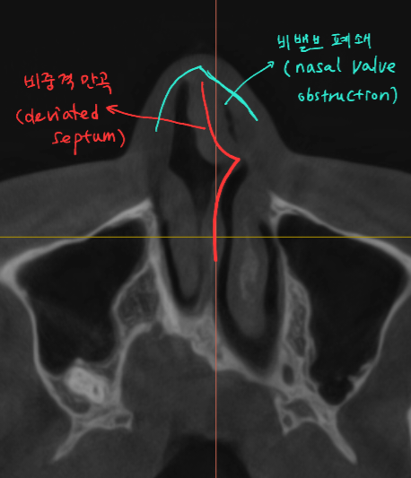 Information You Can Obtain Through CT Scanning During a Consultation for Revision Rhinoplasty image 4
