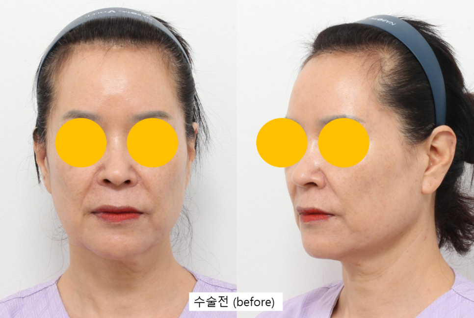 귀족수술을 했는데도 팔자주름이 남는 이유 관련 이미지 3
