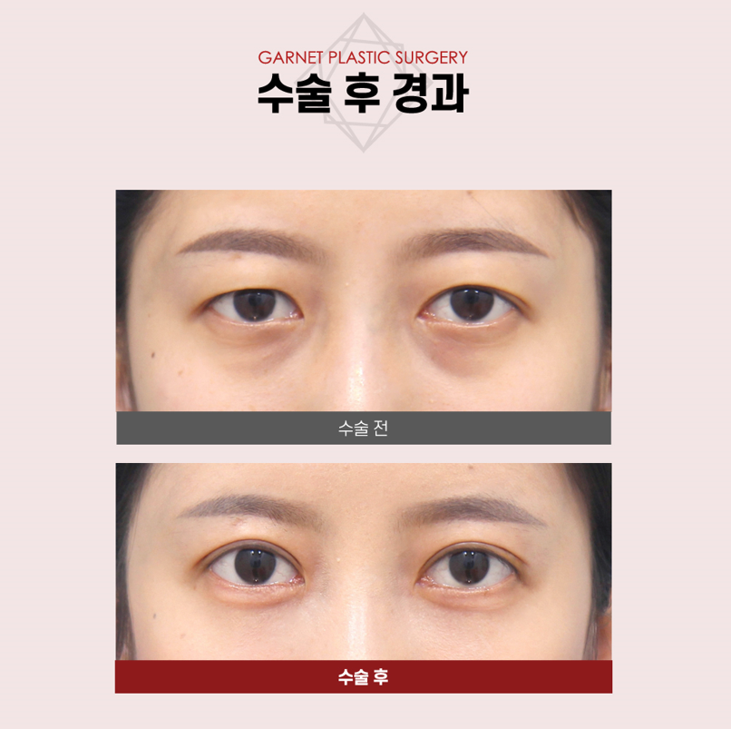 【Garnet Plastic Surgery Director Baek In-su’s Plastic Surgery Column】 Erasing Dark Circles with Under-Eye Fat Repositioning image 5