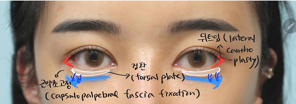 Lateral and Lower Canthoplasty with Under-Eye Fat Repositioning image 7