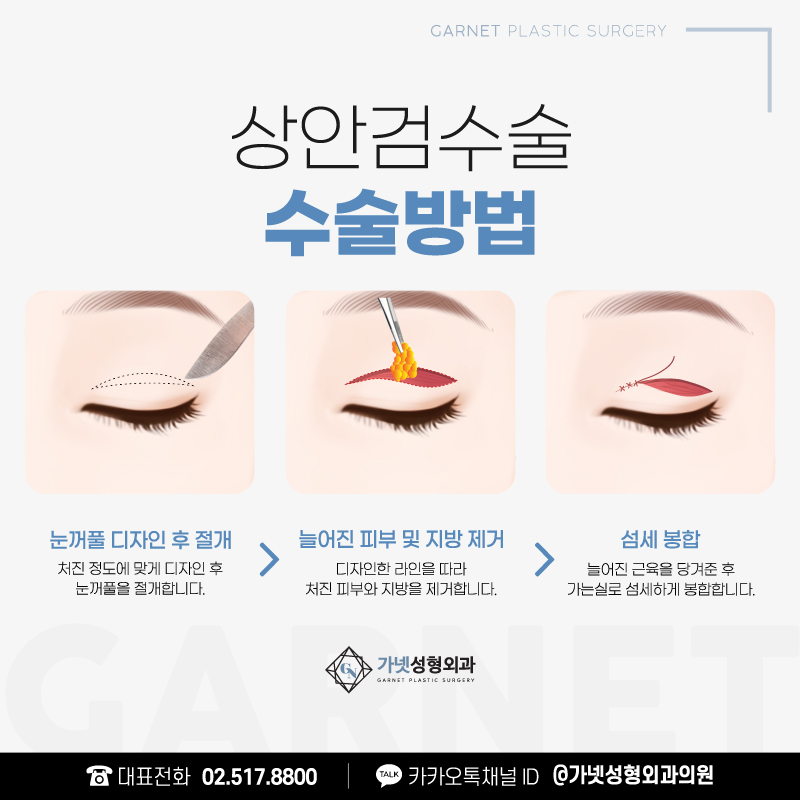 처진눈꺼풀 고민이라면 상안검수술로 또렷한 눈매 갖기 관련 이미지 3