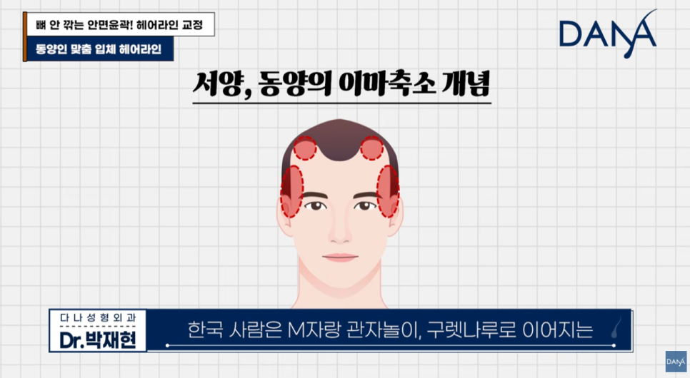 동양인vs서양인 이마 차이, 한국인에게 헤어라인 교정이 필수인 이유 관련 이미지 4