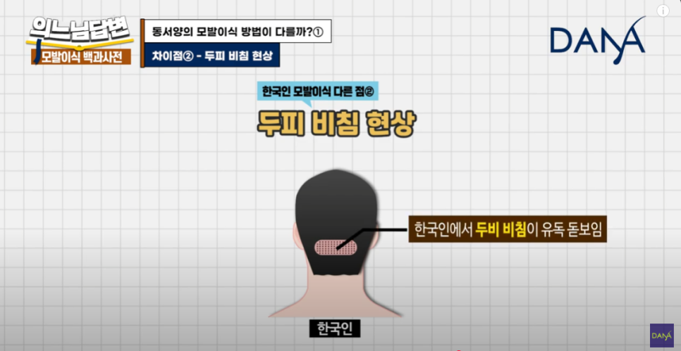 How Is Hair Transplantation Different by Race? image 8