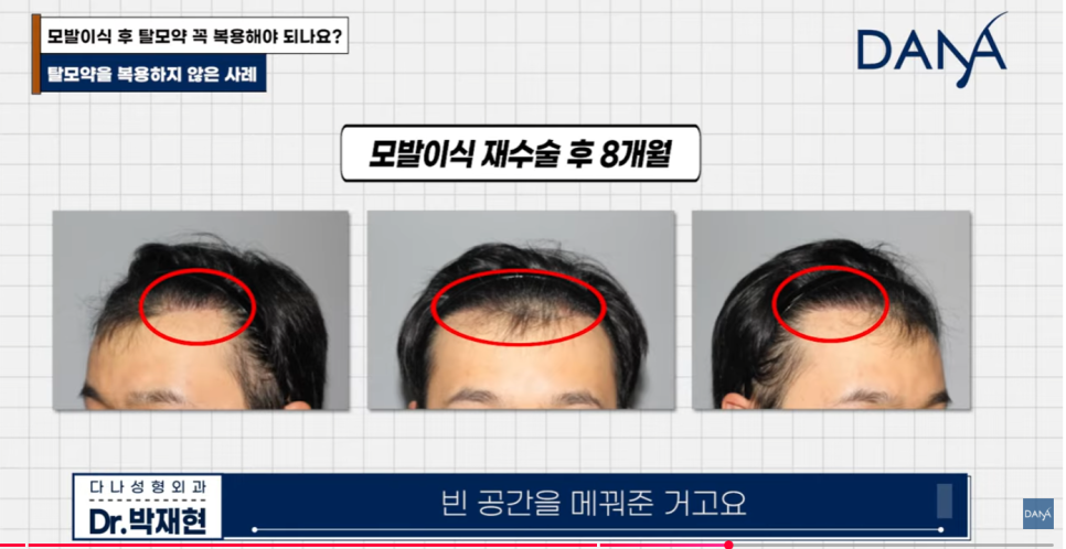 Is Taking Hair Loss Medication Essential After Hair Transplant? What Happens If You Don’t Take Propecia or Avodart image 9