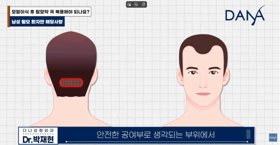 Is Taking Hair Loss Medication Essential After Hair Transplant? What Happens If You Don’t Take Propecia or Avodart image 4
