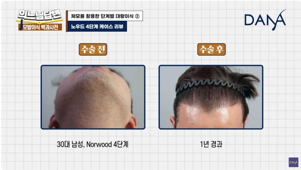 체모이식 체모를 활용한 단계별 대량이식 관련 이미지 19