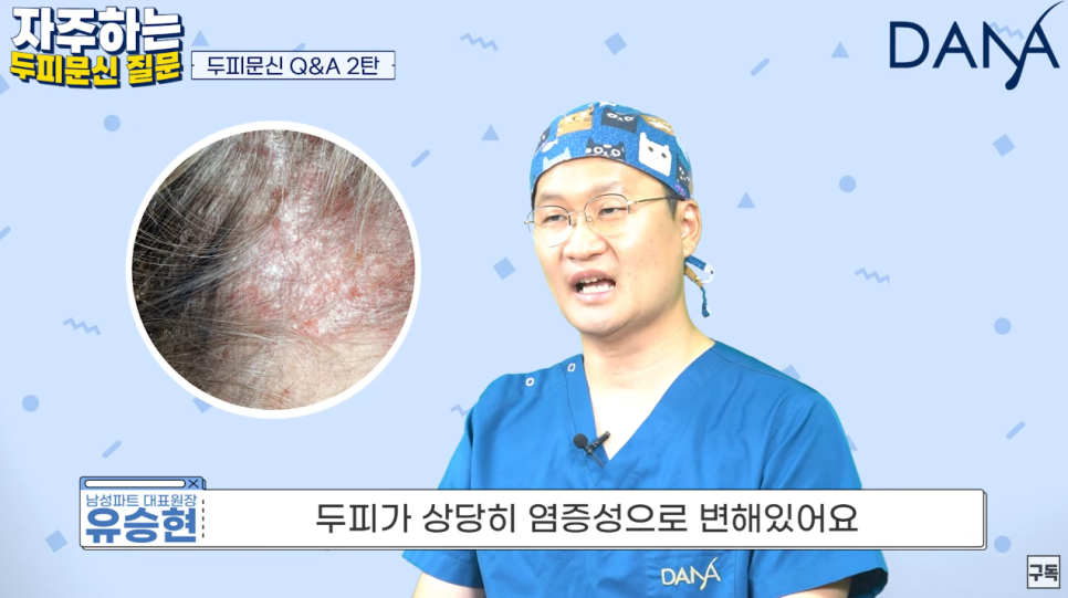 Scalp Micropigmentation: Is the Procedure Possible if You Have Seborrheic Scalp Dermatitis? image 2