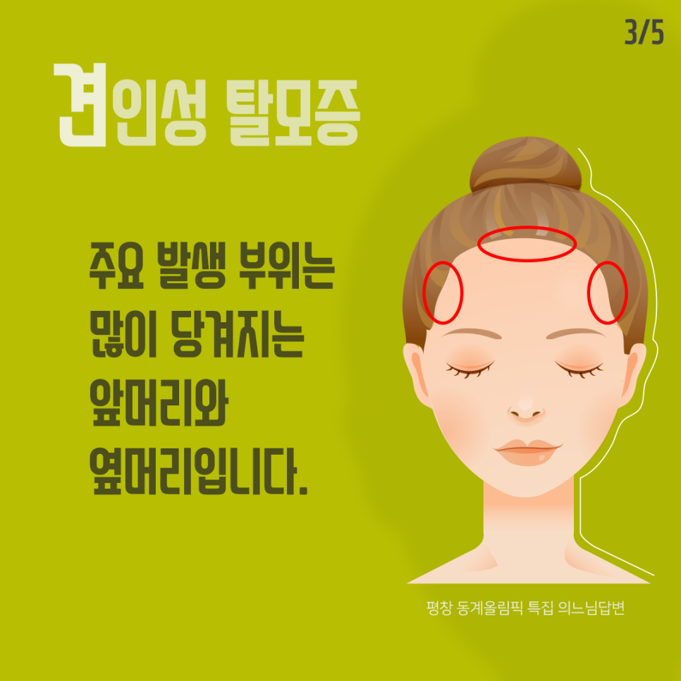 머리를 세게 묶어 오는 견인성 탈모 관련 이미지 4