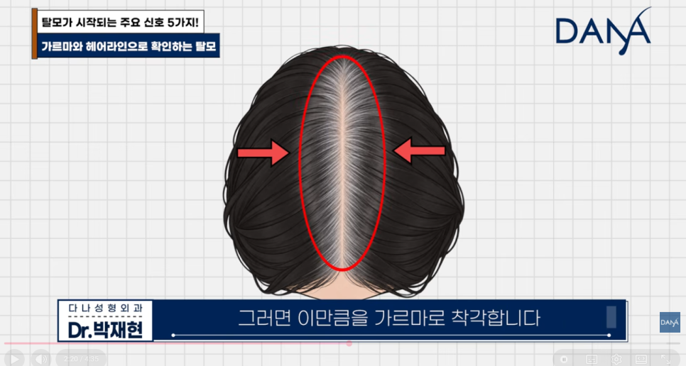 혹시 나도 탈모일까? 초기 증상 5가지와 10초 자가진단법 관련 이미지 17