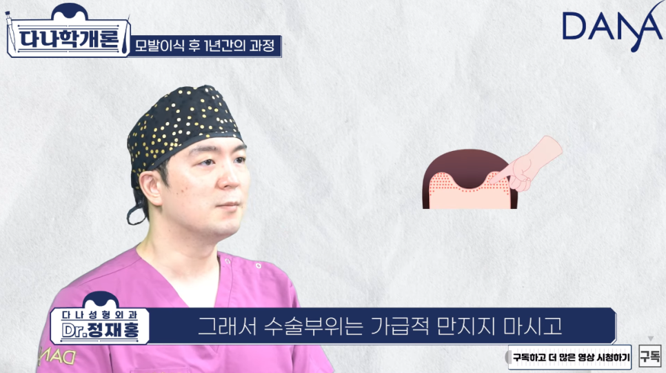 모발이식 1년후 (수술후 머리카락이 자라나는 과정) 관련 이미지 3