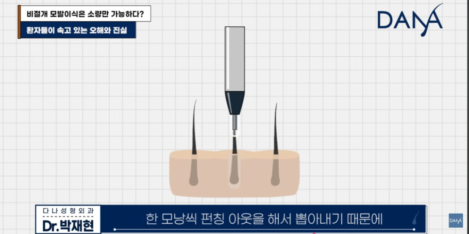비절개 모발이식 왜 소량만 가능하다고 알려졌을까? 관련 이미지 24