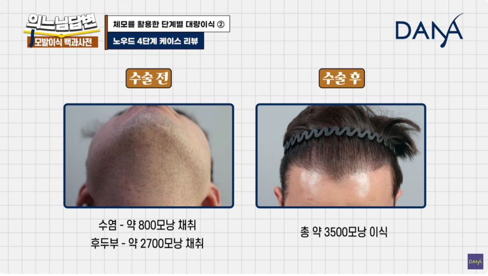 체모이식 체모를 활용한 단계별 대량이식 관련 이미지 20