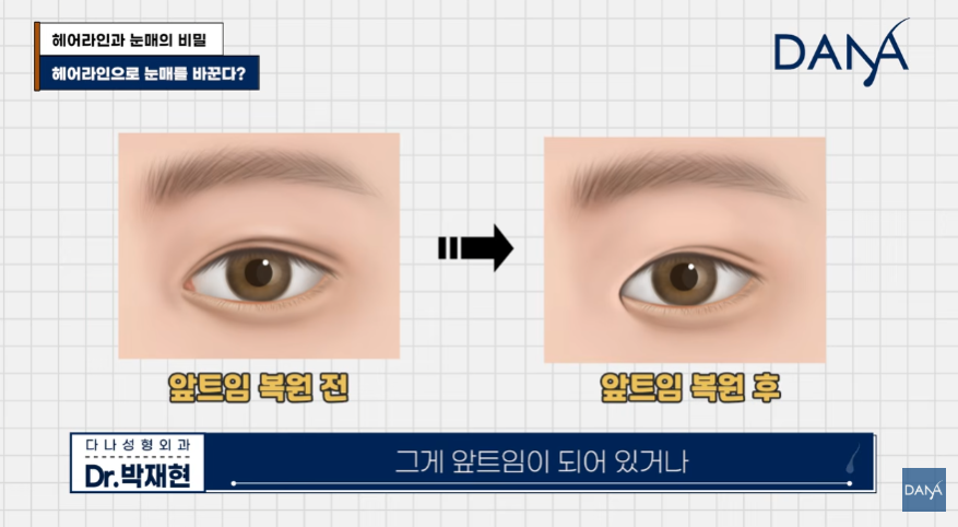 진짜 몰린 눈 VS 가짜 몰린 눈! 눈매가 답답해 보이는 진짜 이유 관련 이미지 7