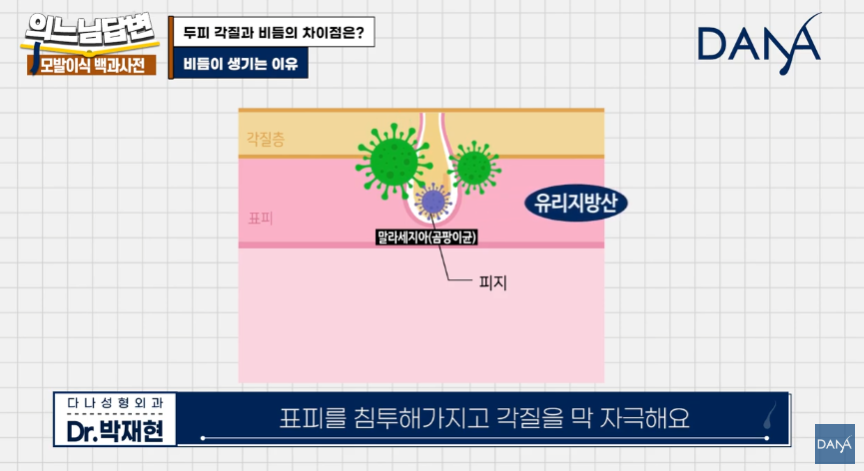 머리 잘 감아도 비듬 생기는 뜻밖의 원인! 두피 각질 차이 및 해결법 관련 이미지 7