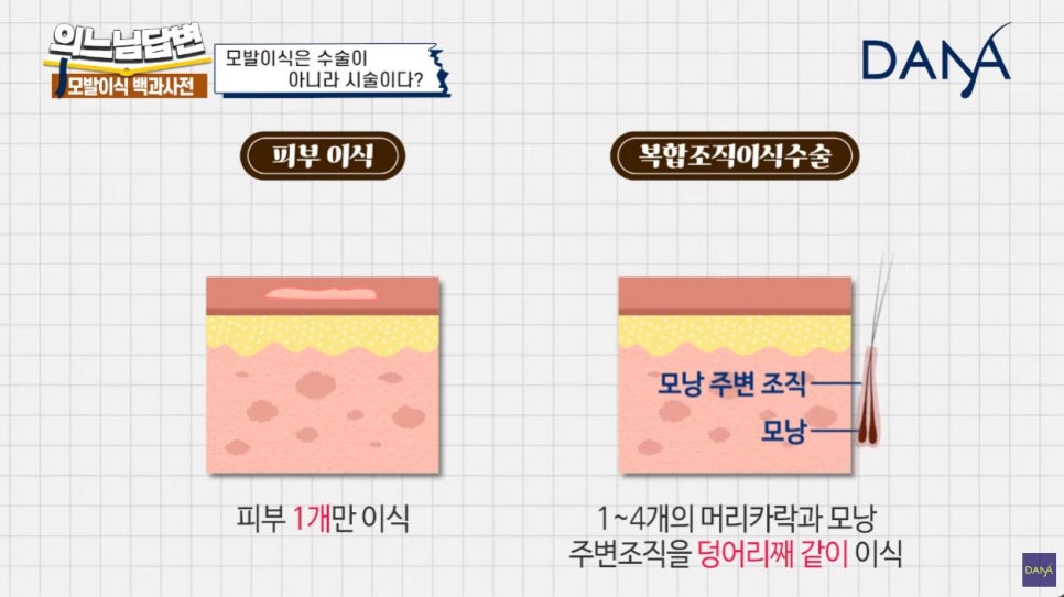 모발이식, 수술일까? 시술일까? 관련 이미지 7