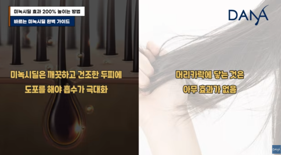 바르는 미녹시딜 부작용 없이 효과 200% 높이는 올바른 사용법 총정리 관련 이미지 12