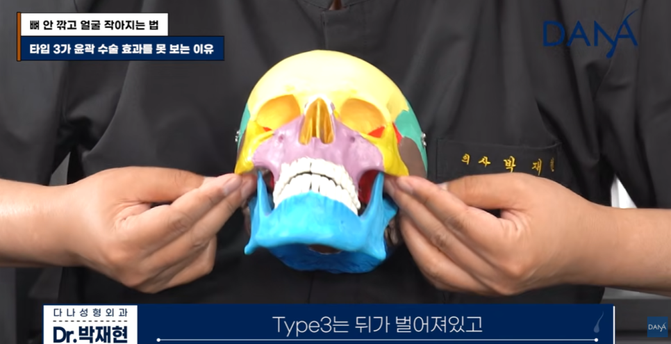뼈 안 깎고 얼굴 작아지는 법? 광대 수술 효과 없는 관련 이미지 10