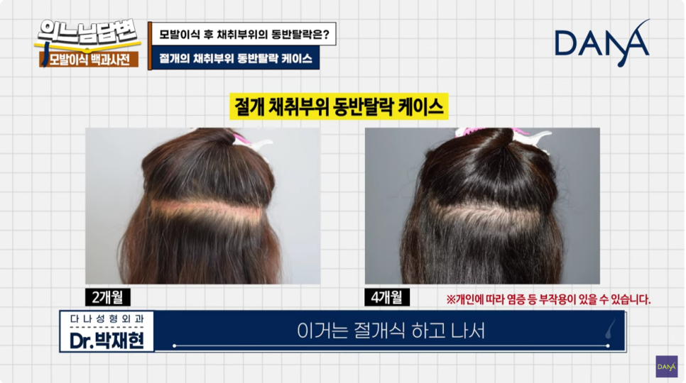 Hair Transplant Donor-Site Shedding That Can Occur After Hair Transplant Surgery image 7