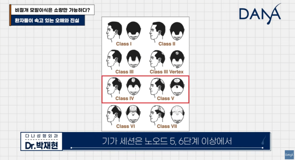비절개 모발이식 왜 소량만 가능하다고 알려졌을까? 관련 이미지 3