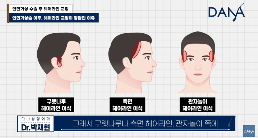 안면거상술 후 흉터와 헤어라인 변형, 자연스럽게 해결하는 방법 관련 이미지 17