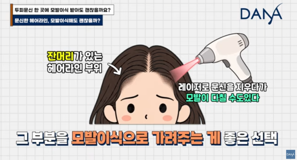 헤어라인 문신 망했는데 모발이식 가능할까? 생착률 걱정된다면 필수 체크 관련 이미지 4