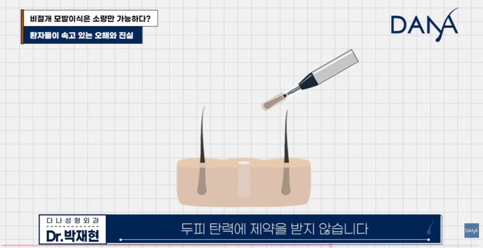 비절개 모발이식 왜 소량만 가능하다고 알려졌을까? 관련 이미지 25