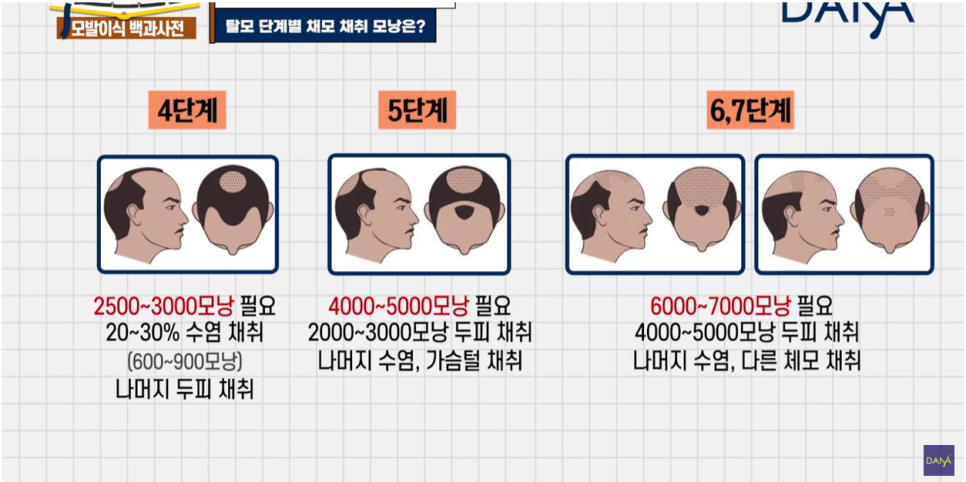 체모이식 체모를 활용한 단계별 대량이식 관련 이미지 13