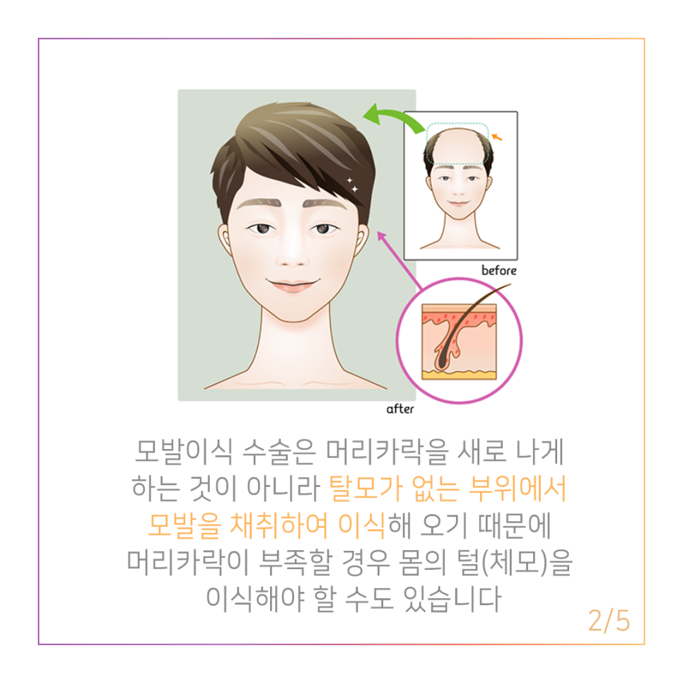 Put Body Hair on the Head? Body Hair Transplant, Dr. Park Jae-hyun of Dana Plastic Surgery image 2