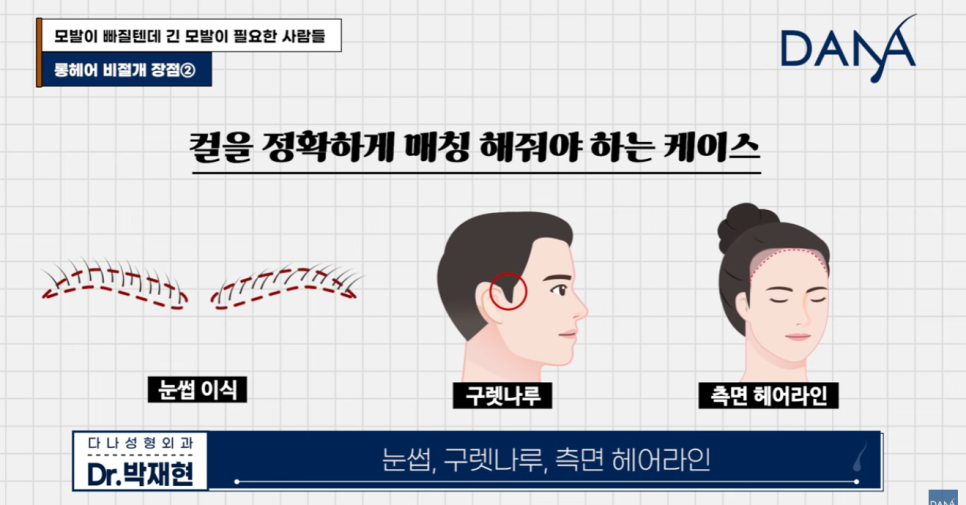 The Secret Behind Long-Hair, Non-Incisional Hair Transplants Chosen by Celebrities and CEOs—Staying Undetectable Even During the Shedding Phase image 10